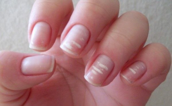 tratamiento para las manchas blancas en las uñas