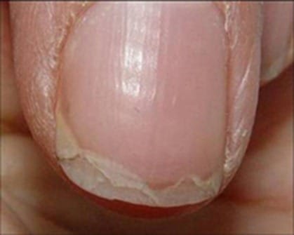 tratamiento para uñas quebradizas, que se rompen o parten por capas