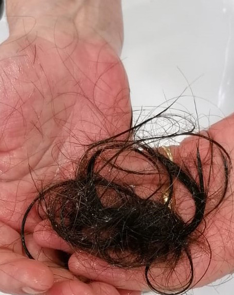 Otra secuela del covid 19 es la caida masiva de cabello